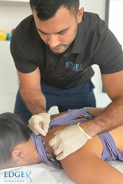 Therapist Conducting Dry Needling Therapy on a Patient