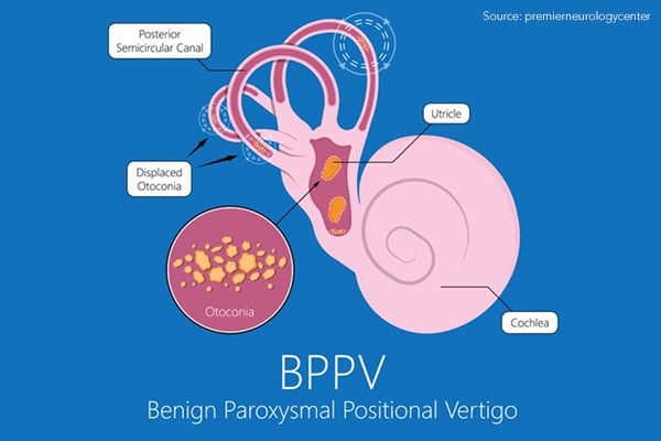 BPPV benign paroxysmal positional vertigo