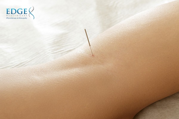 Pinpoint your pain and recover faster with dry needling singapore